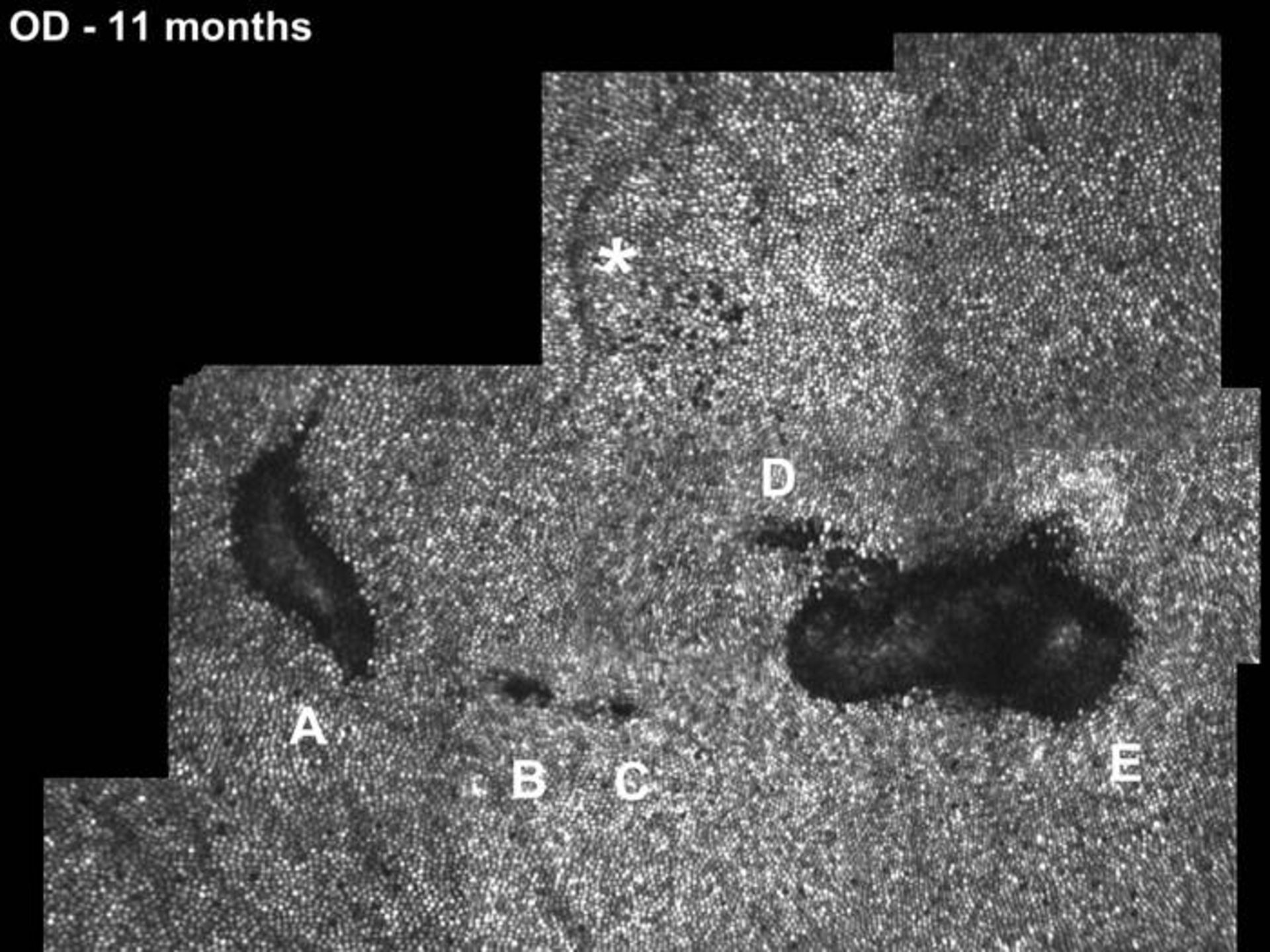آسیب به شبکیه چشم در اثر اشاره گر لیزر