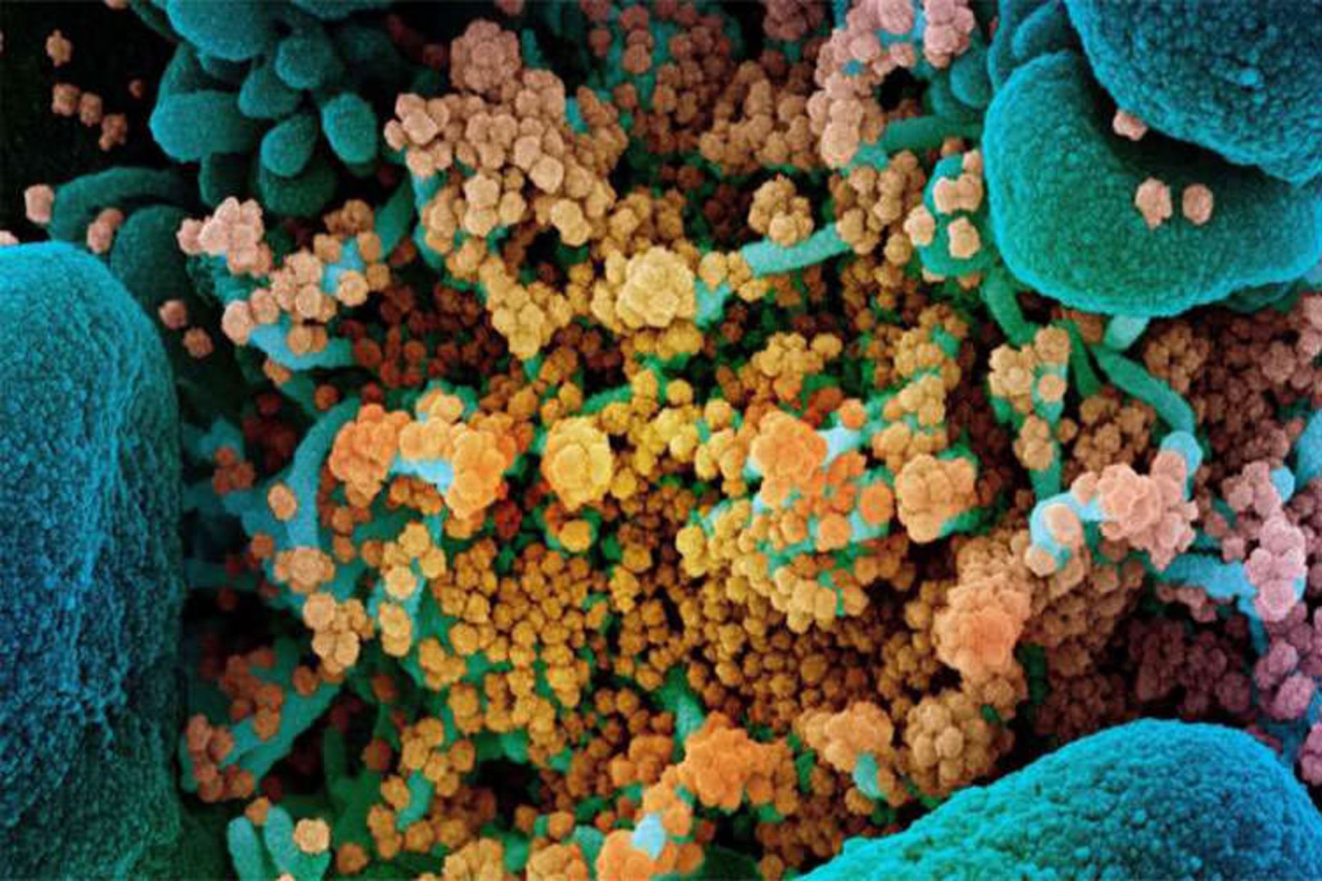 تصویر میکروسکوپی حمله ویروس کرونا به سلول های بدن