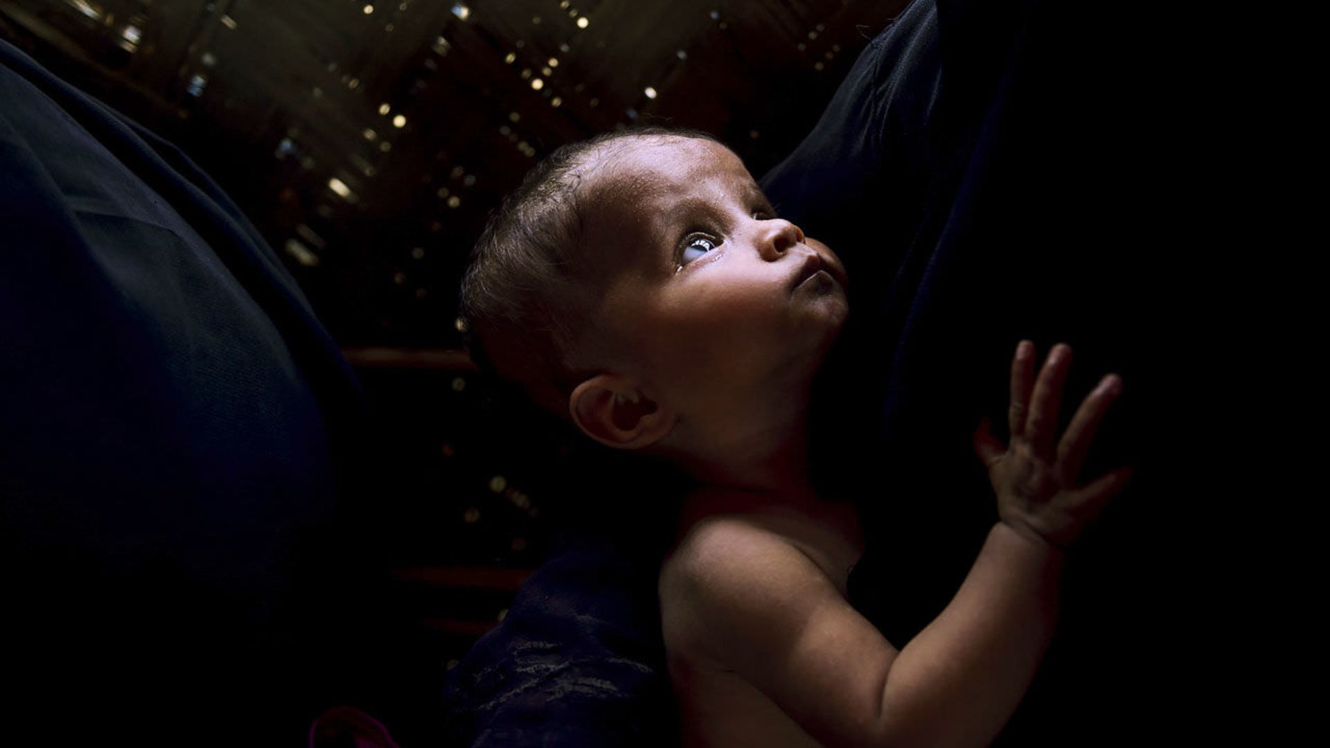 کودک دچار سوء تغذیه در بنگلادش