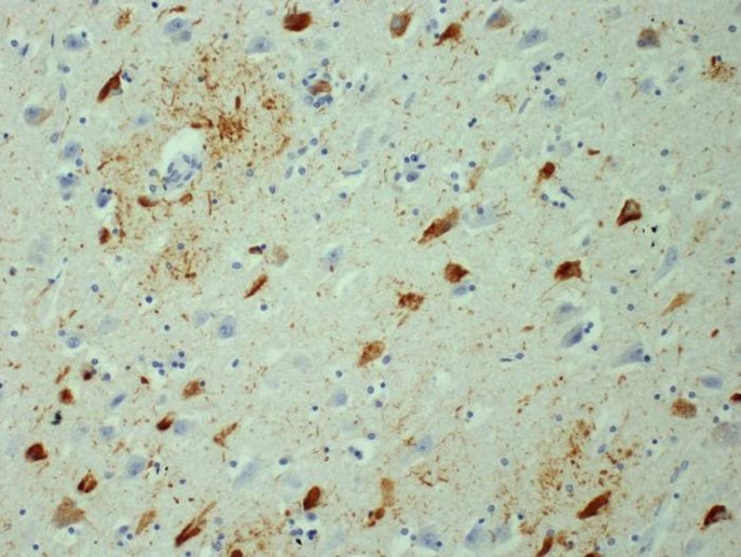توده های پروتئین تائو در آلزایمر