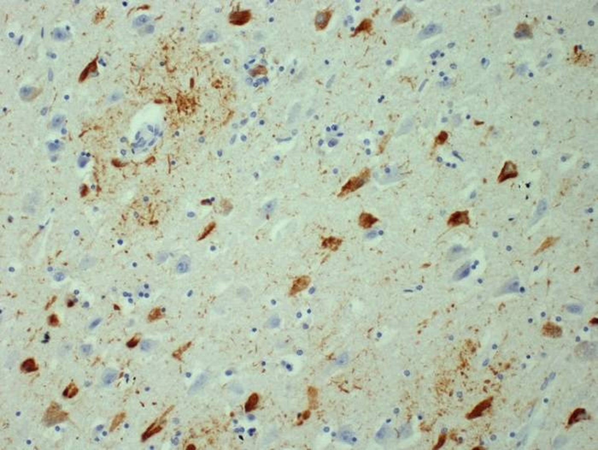 توده های پروتئین تائو در آلزایمر