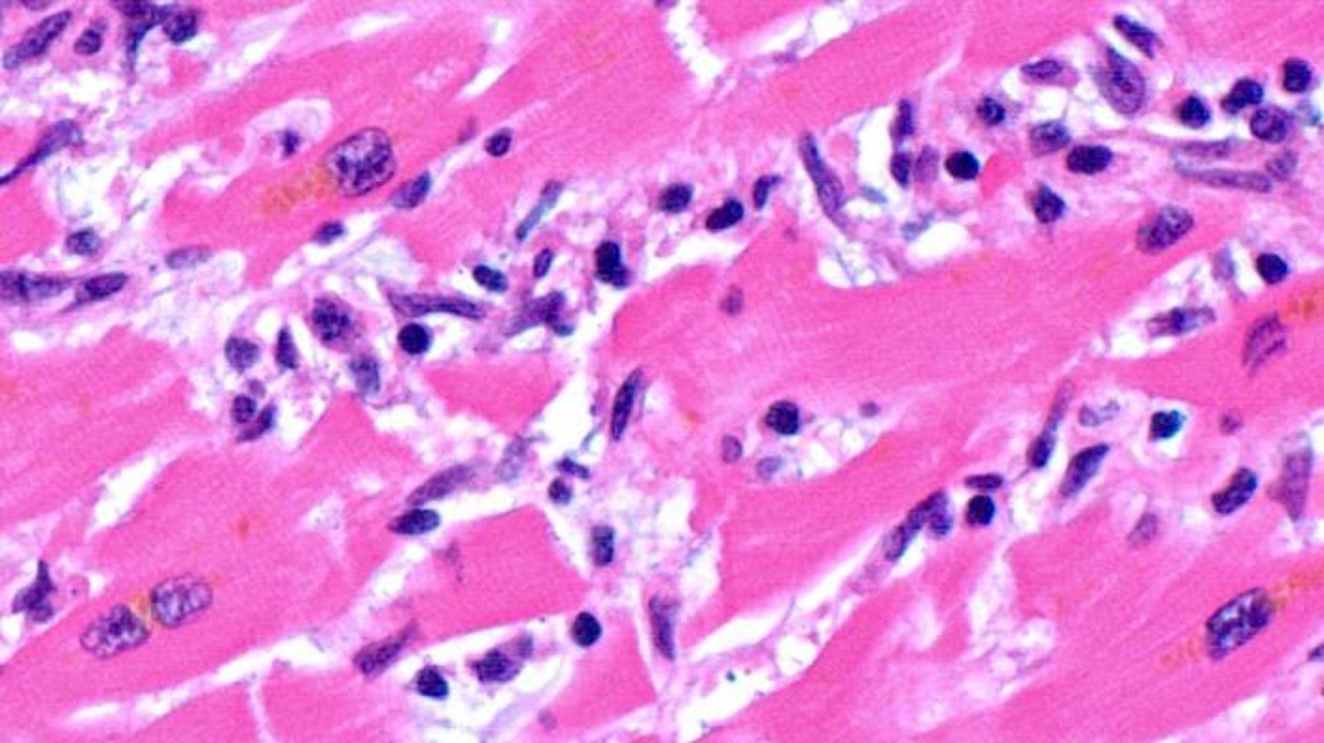 حمله سلول های التهابی به قلب بیمار کووید 