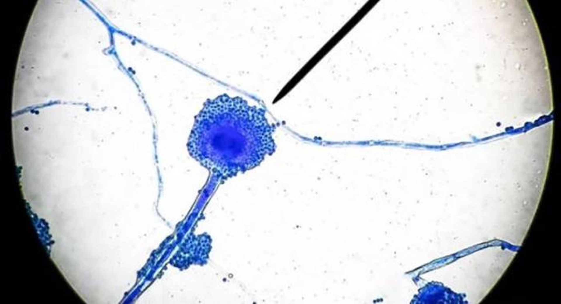 عفونت قارچ سیاه