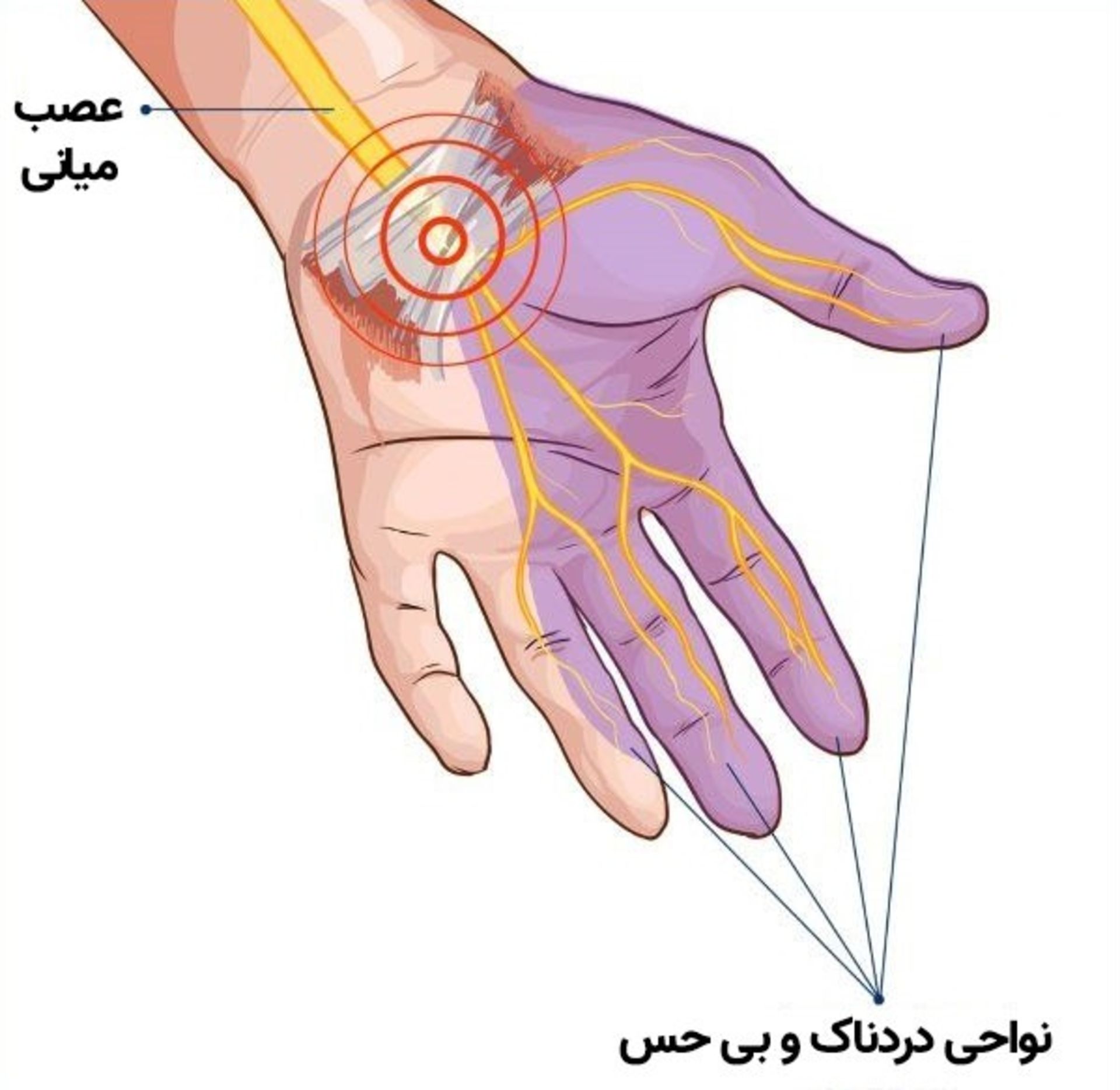 عصب میانی سندروم تونل کارپال