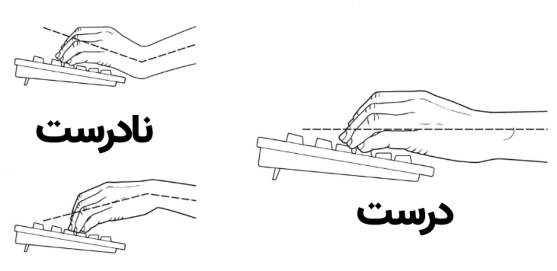 استفاده صحیح از کیبورد - سندروم تونل کارپال