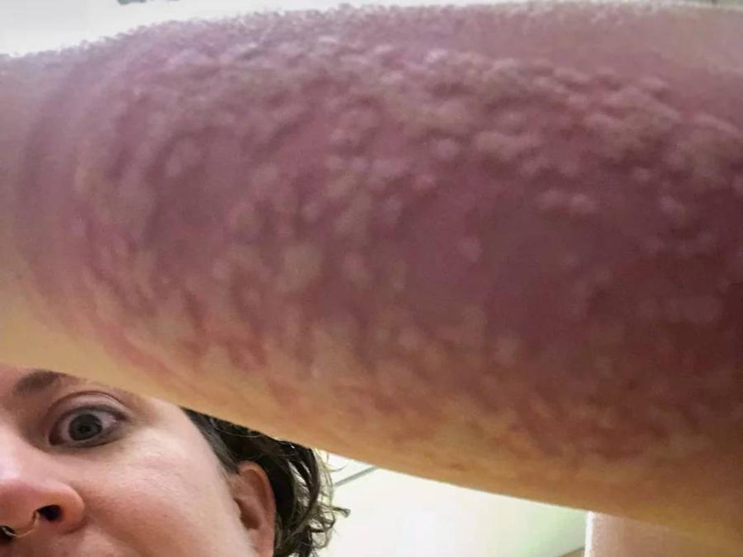بازوی شرکت کننده در کارآزمایی پس از نیش پشه / arm swelling 