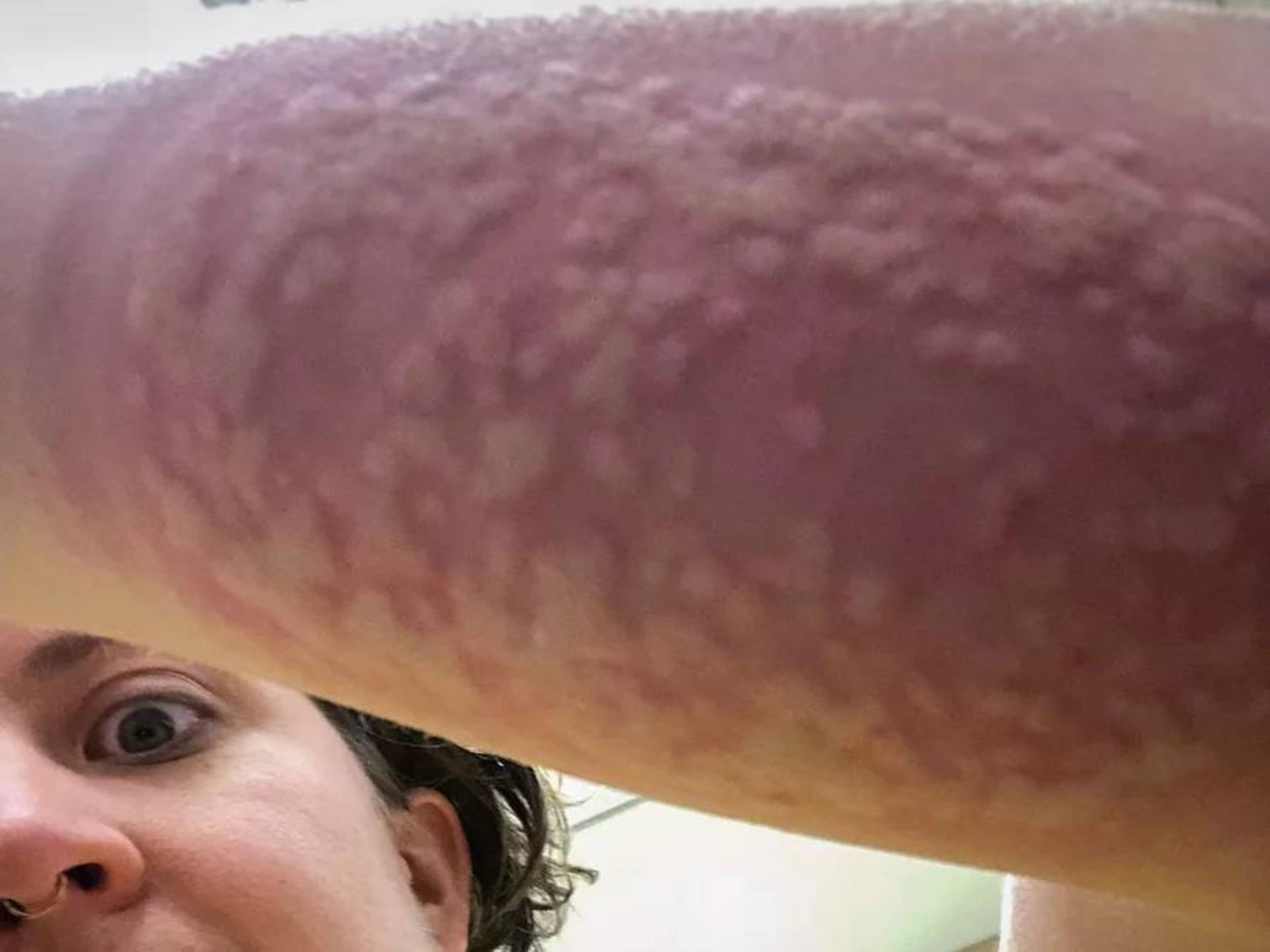 بازوی شرکت کننده در کارآزمایی پس از نیش پشه / arm swelling 