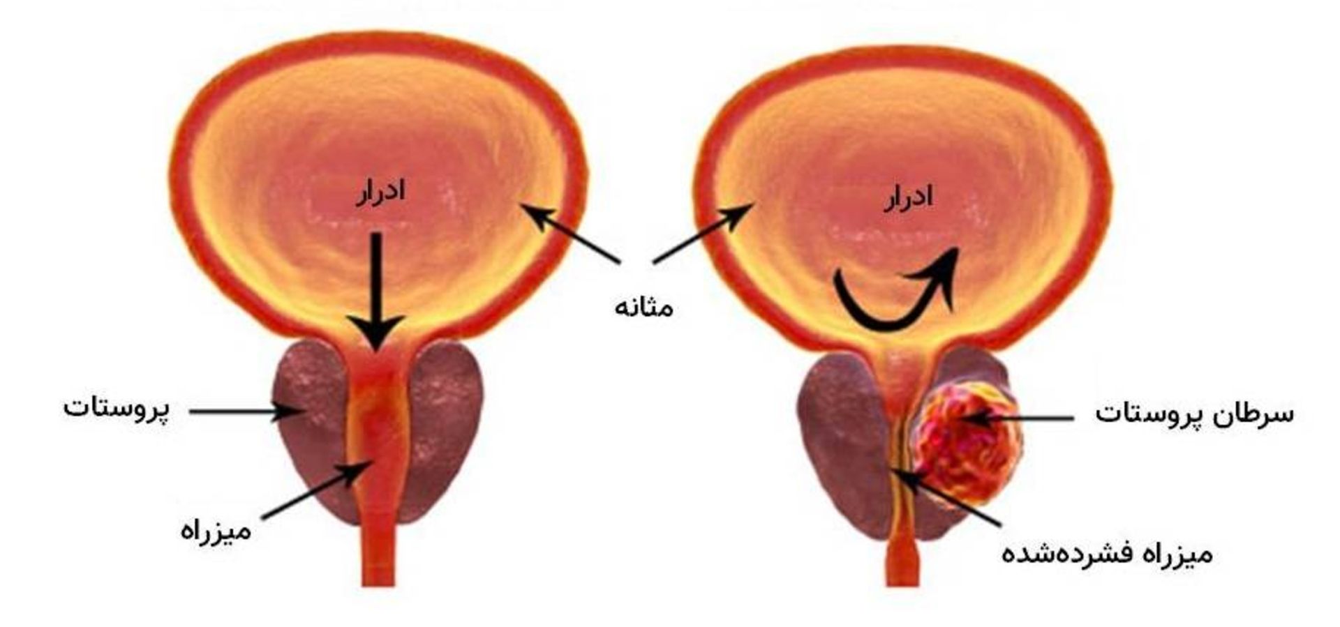 سرطان پروستات / Prostate cancer