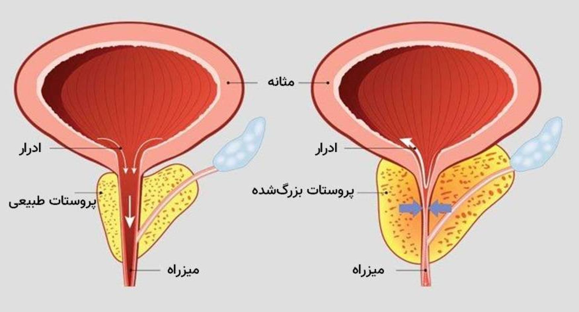 بزرگ شدن پروستات / 	Benign prostatic hyperplasia