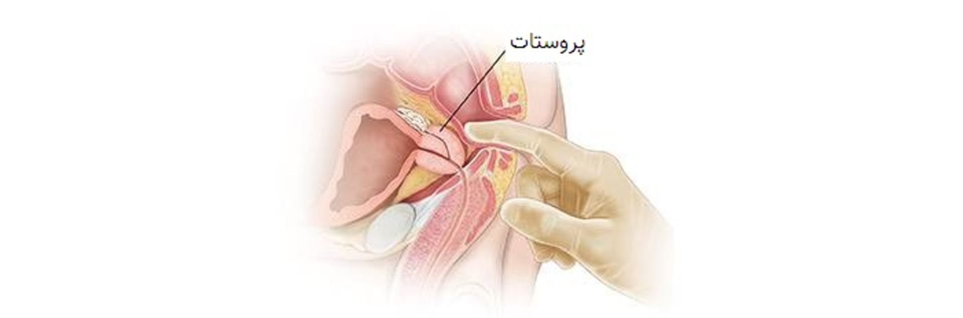 معاینه مقعدی برای تشخیص بیماری های پروستات / rectal exam