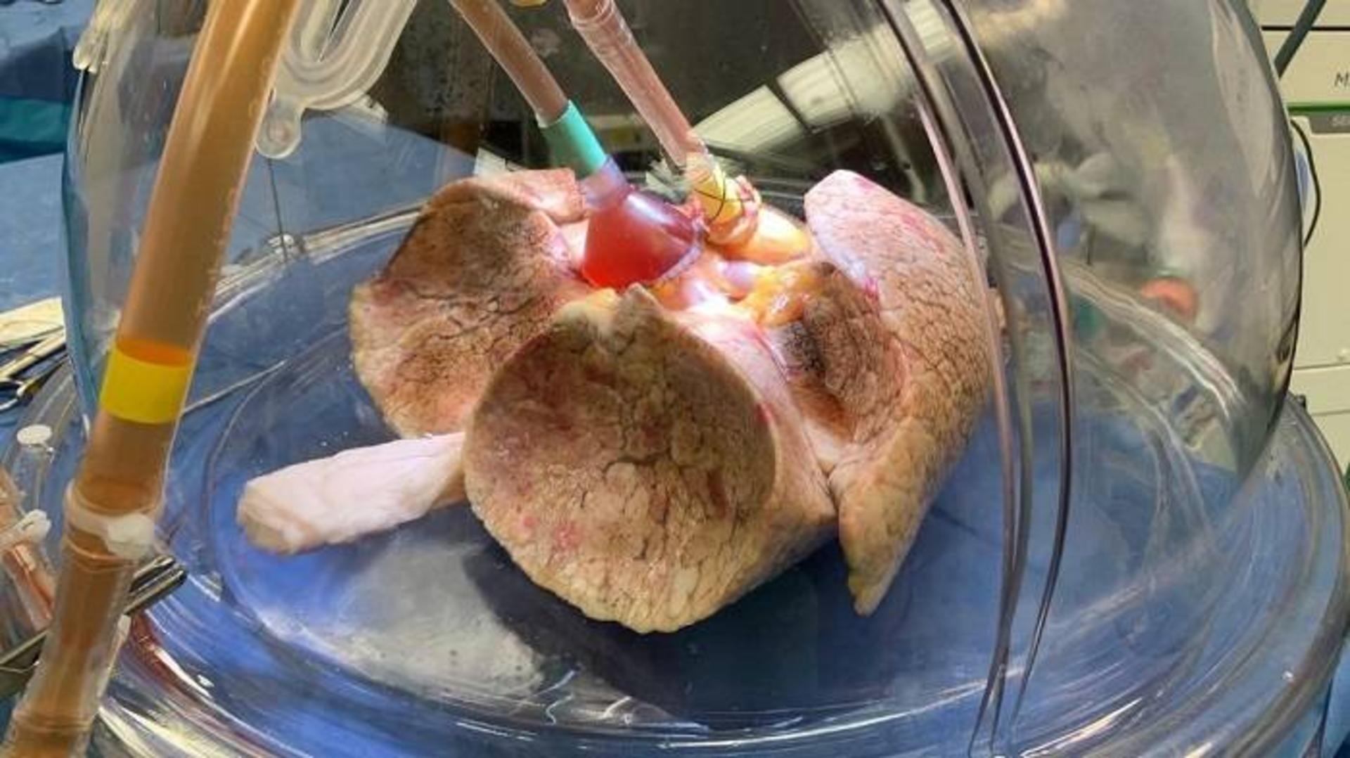 ریه اهدایی برای پیوند ریه / donated lungs