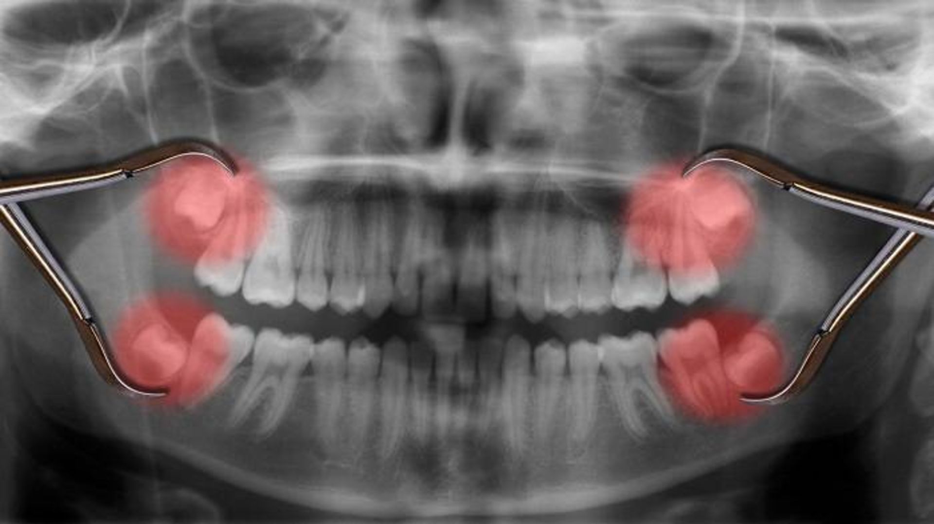دندان های عقل / wisdom teeth