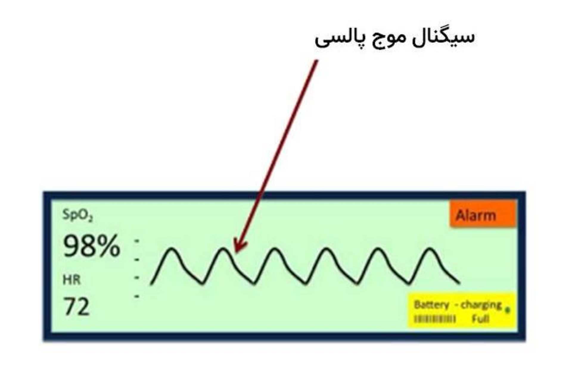 موج پالسی روی نمایشگر پالس اکسیمتر /pulse wave 