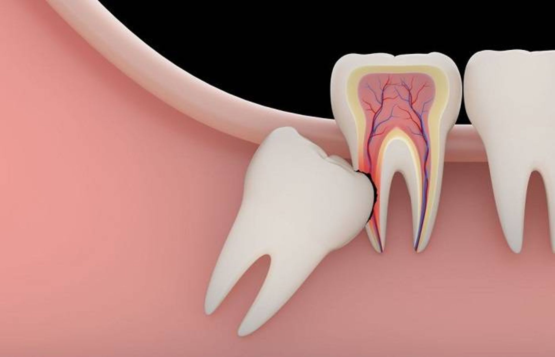 آسیب دندان عقل به دندان های مجاور / wisdom tooth 