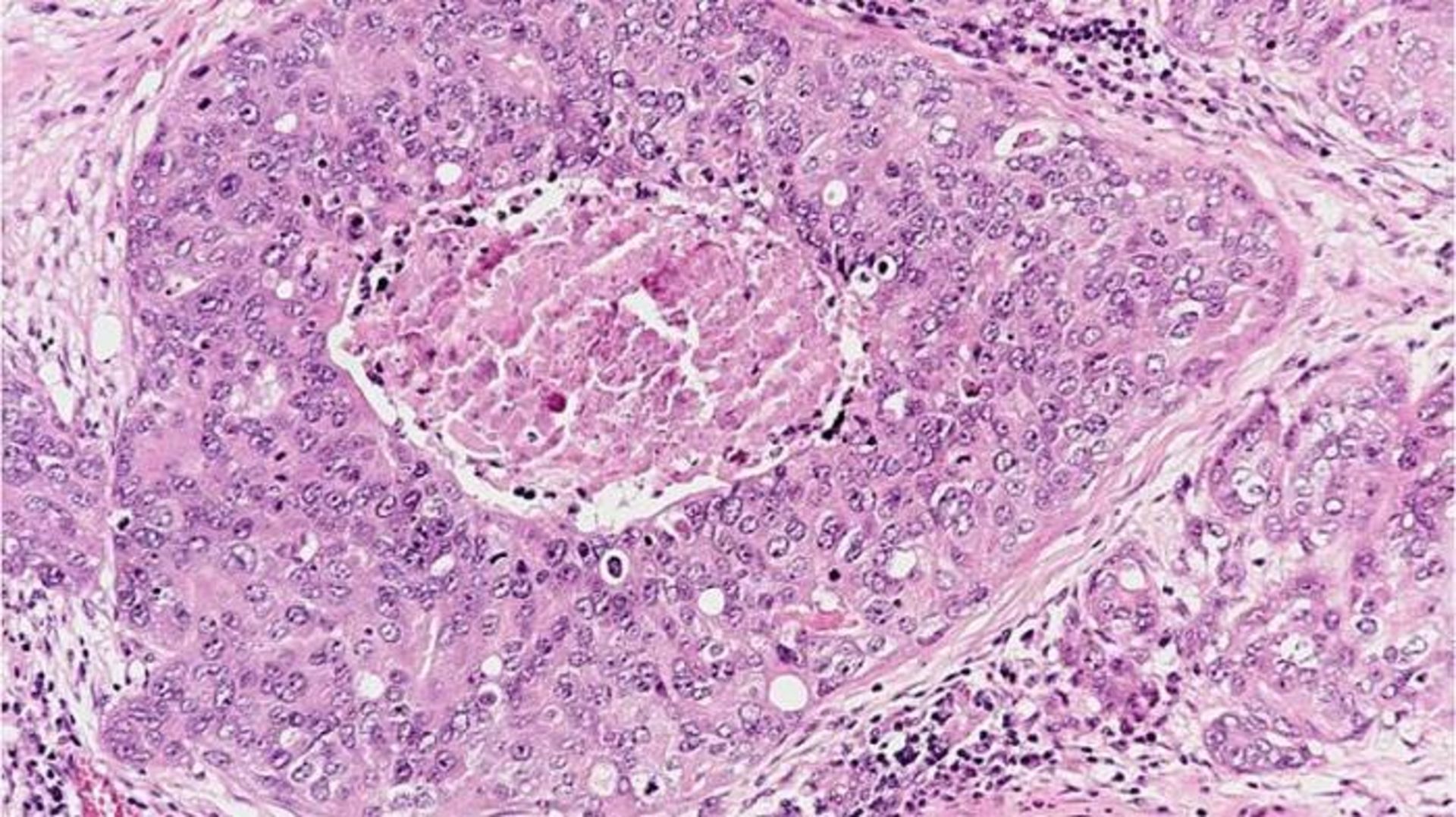 سلول های سرطان سینه / cancer