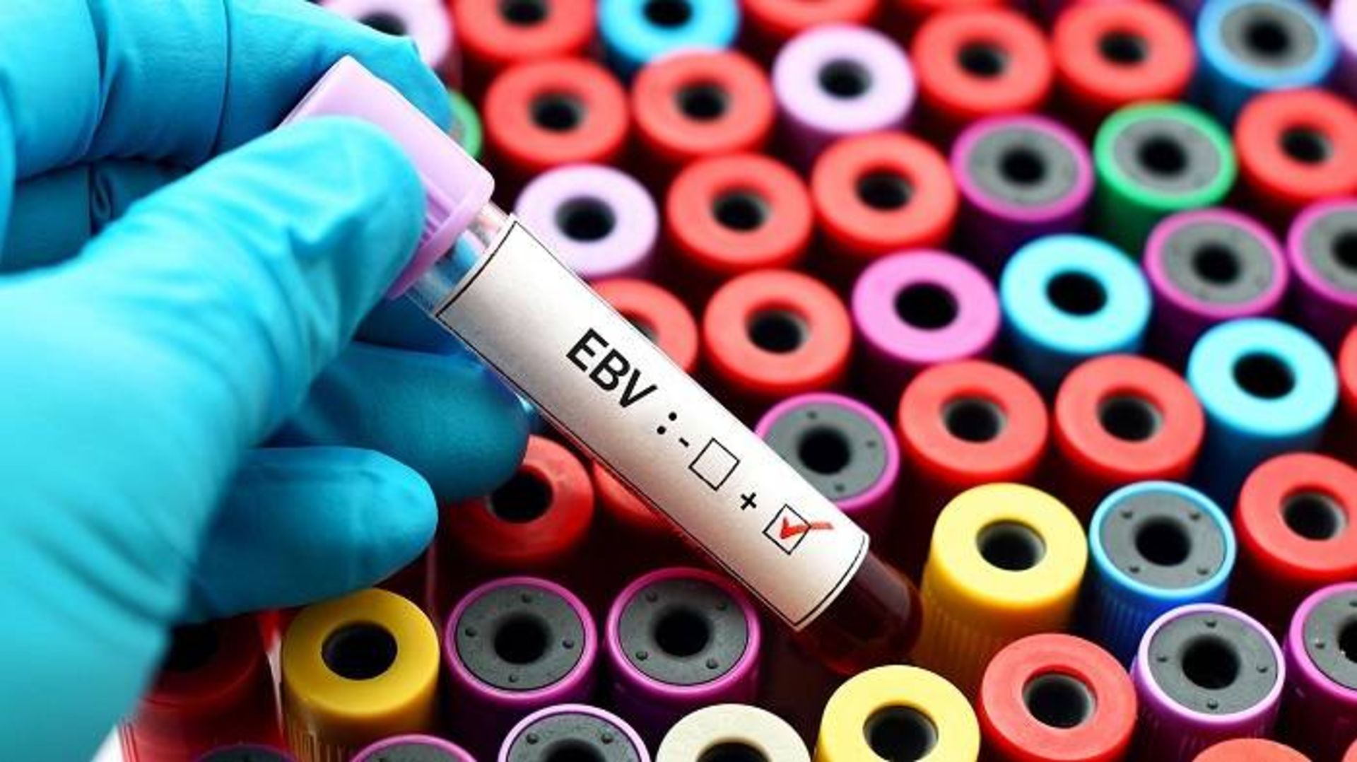 تست تشخیص ویروس اپشتین بار / EBV test