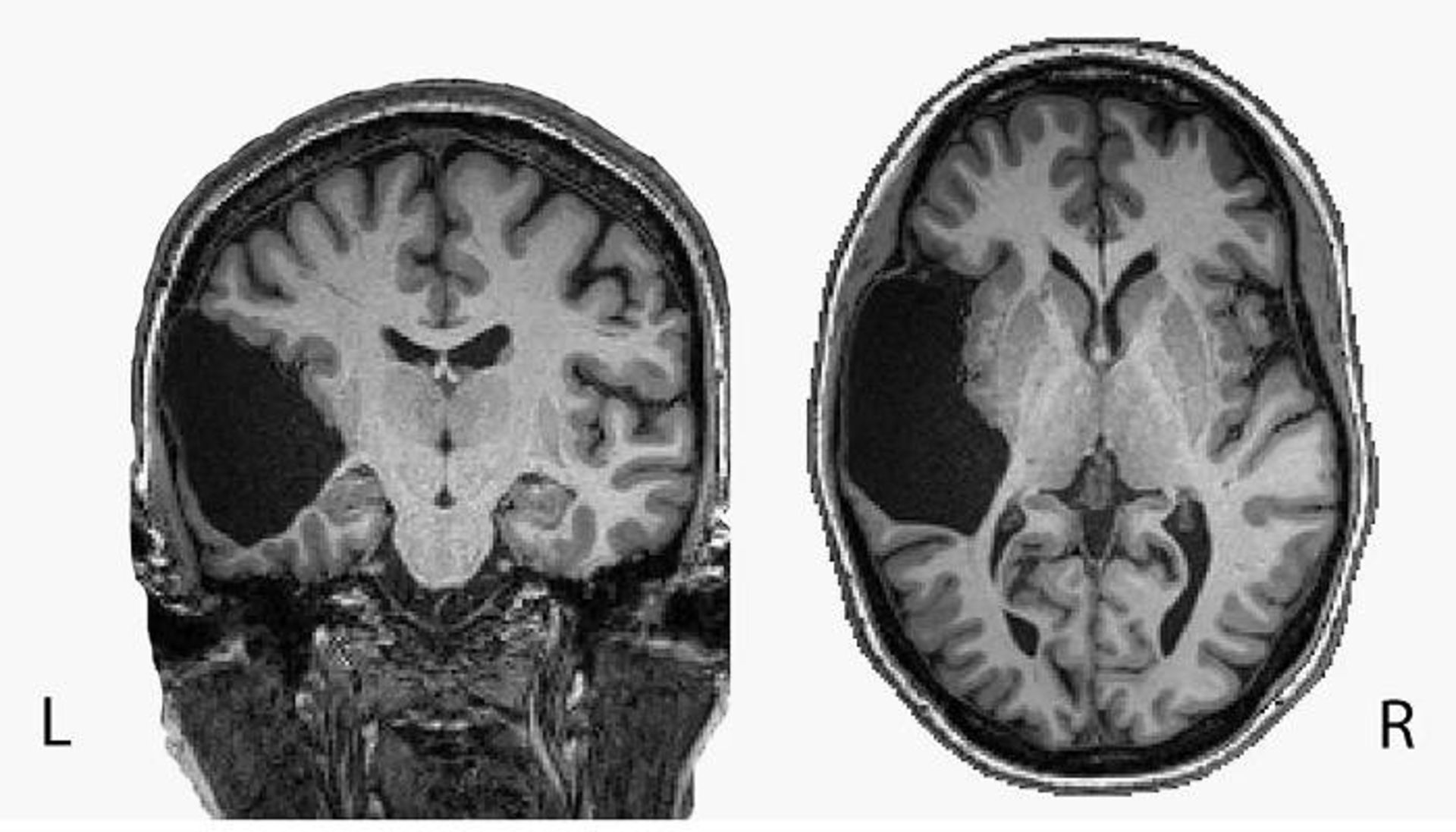 اسکن مغز ای جی / brain scan
