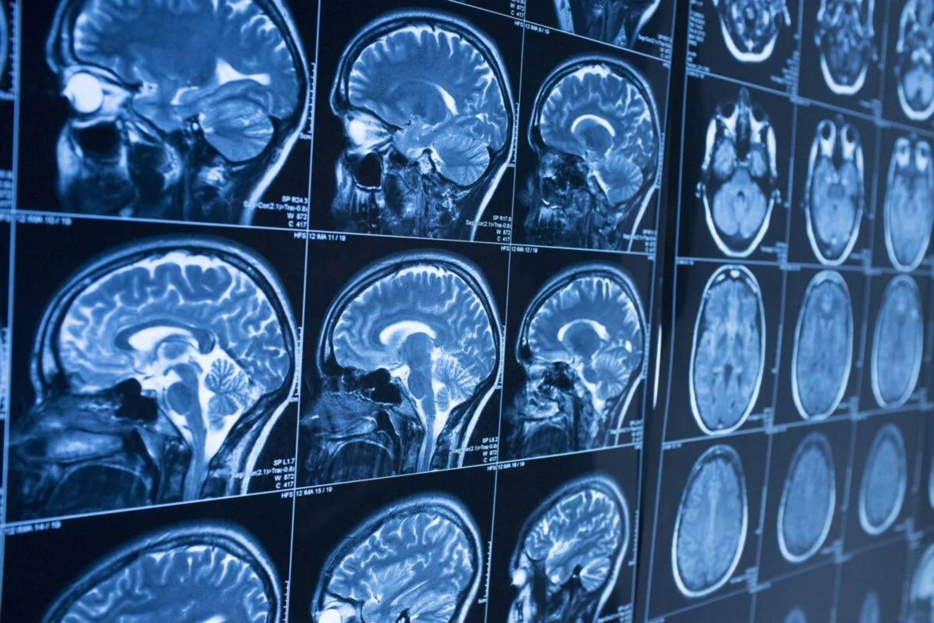 MRI technology uncovers connections between brain activity and psychology