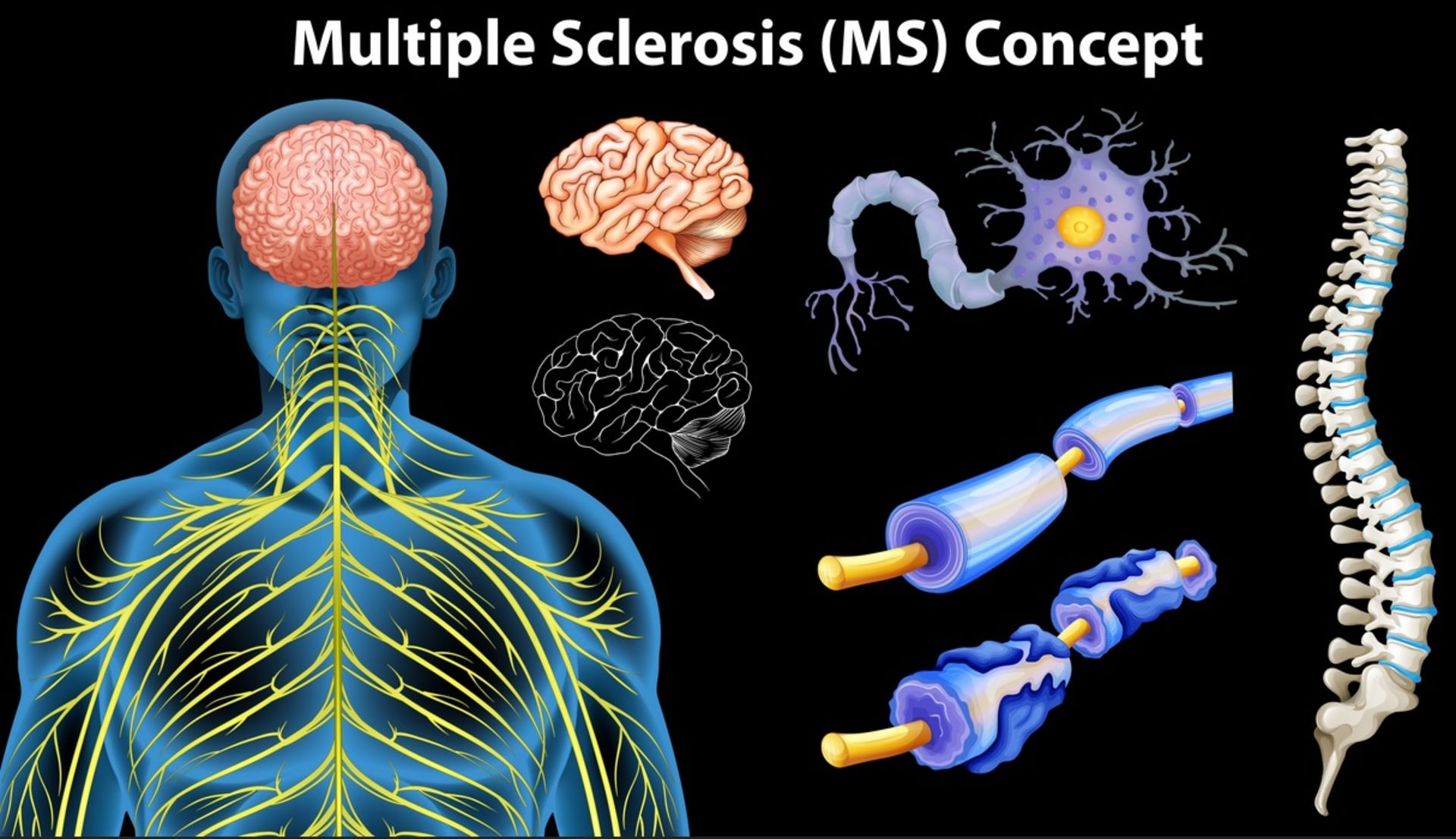 بیماری ام اس سیستم عصبی بدن انسان
