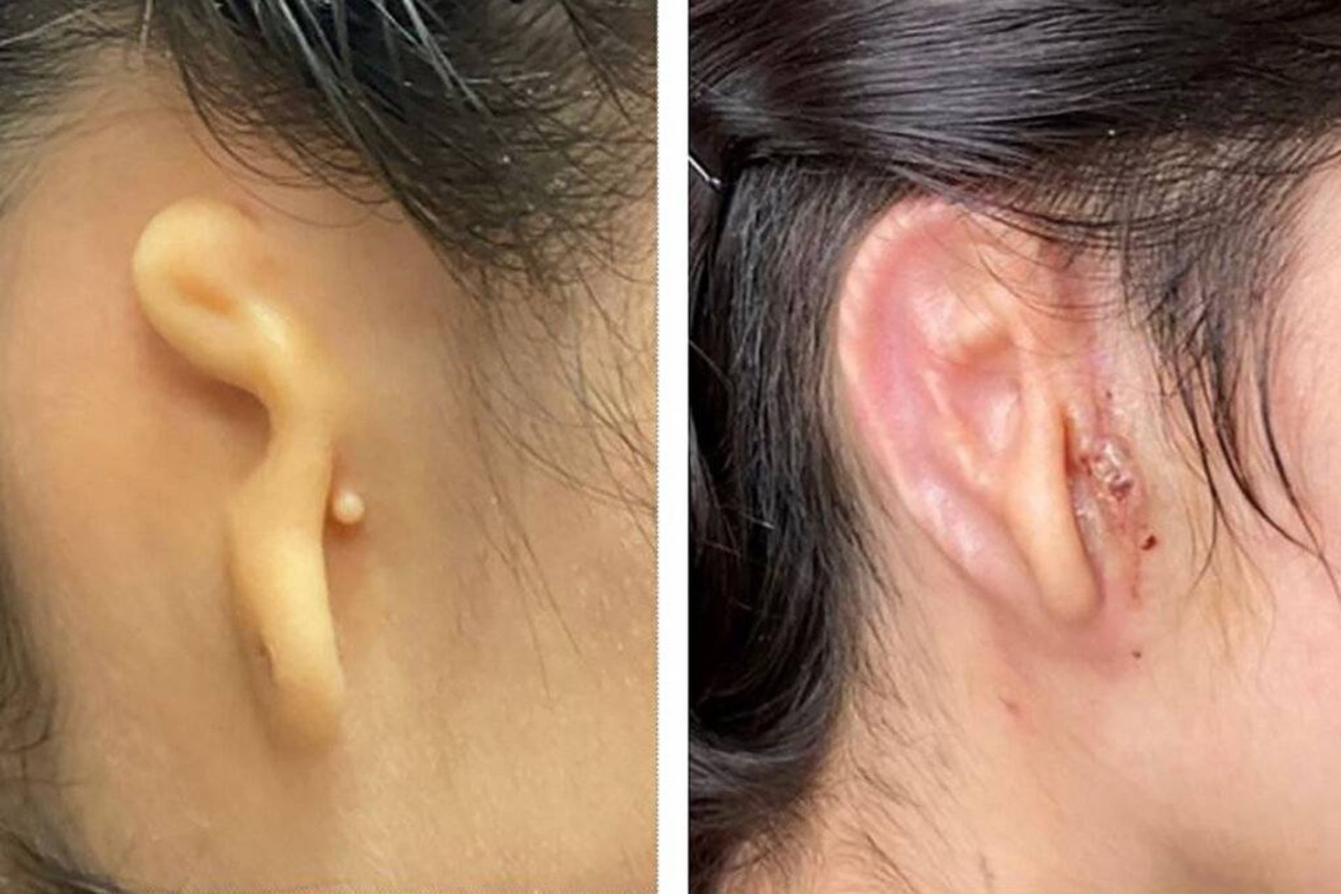 ایمپلنت گوش بیمار / ear implant 