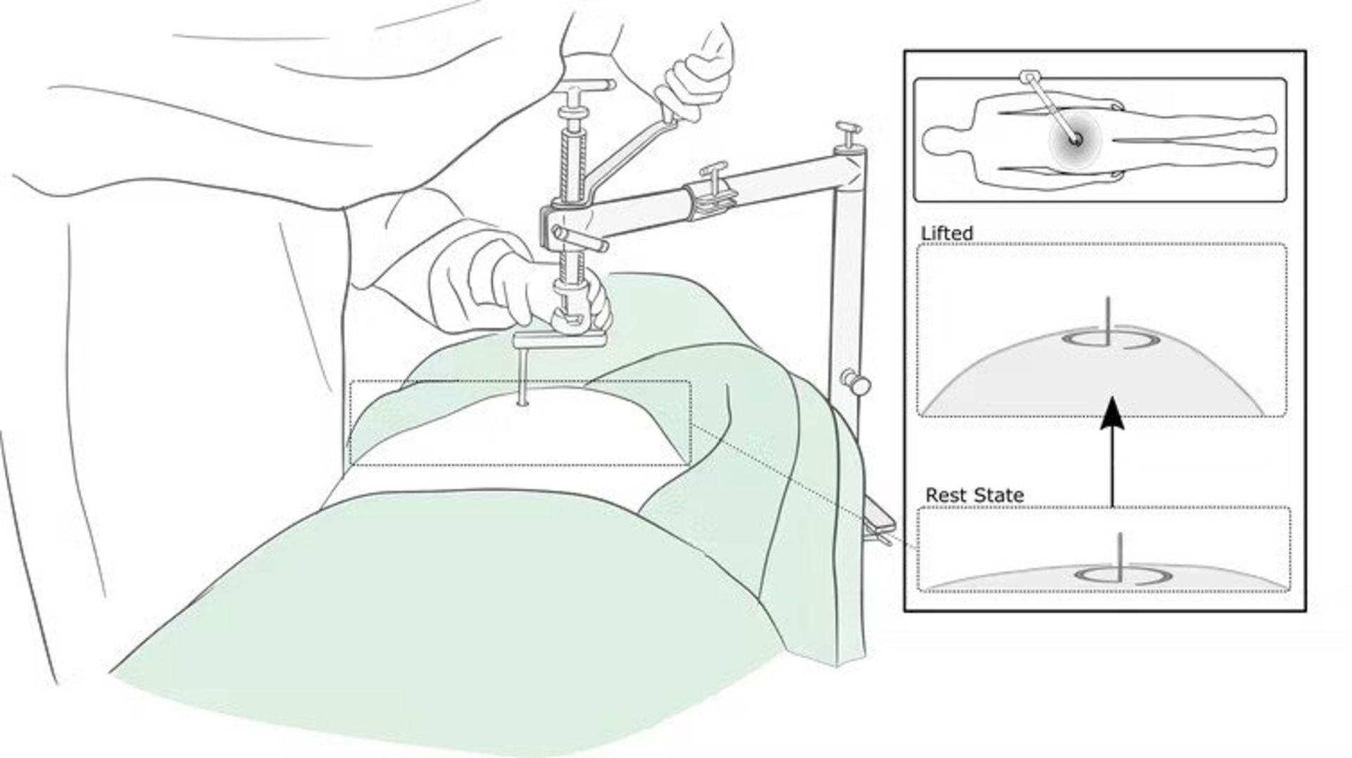 جراحی لاپاراسکوپی بدون گاز