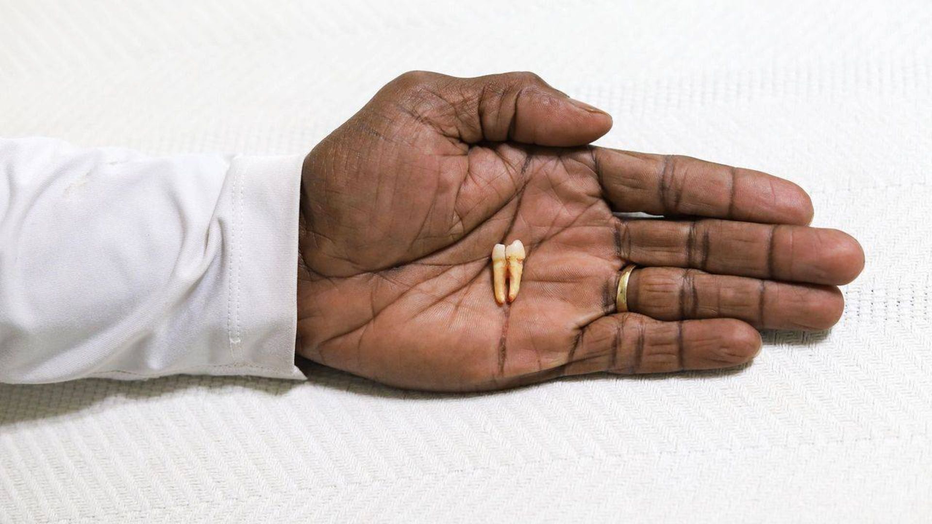 دندان افتاده / tooth