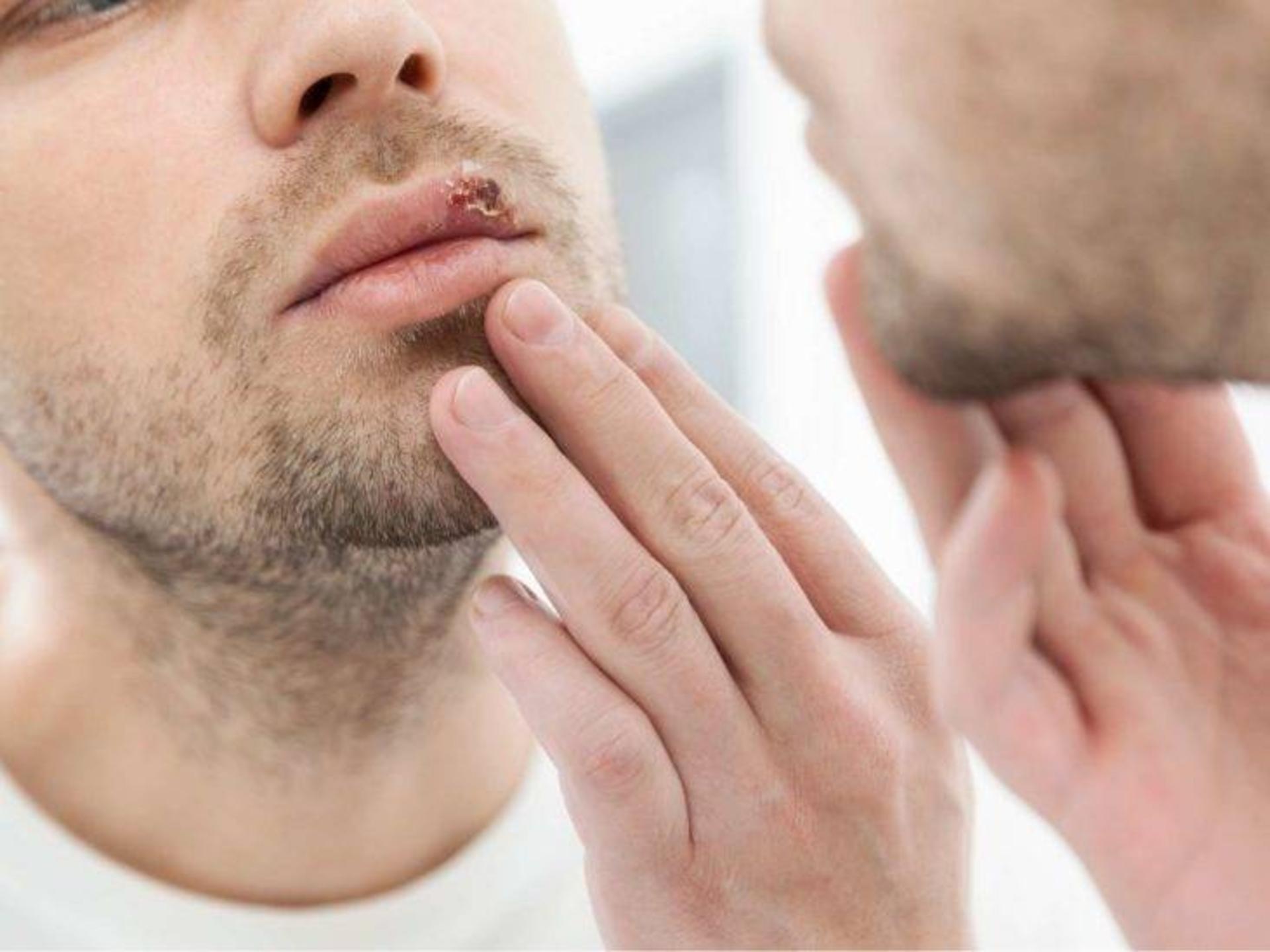 هرپس / Herpes