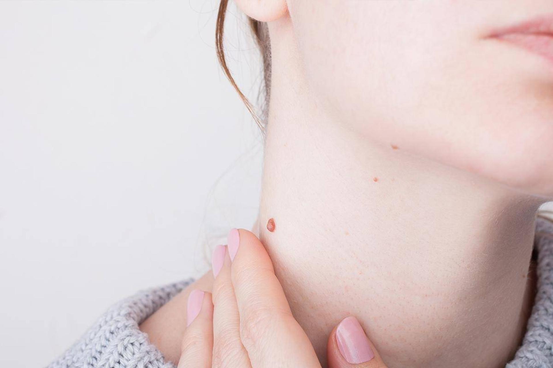 هرآنچه باید درباره عفونت ویروس پاپیلومای انسانی (HPV) بدانید