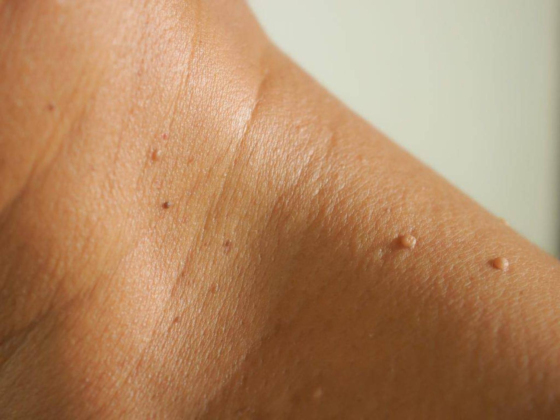 زگیل ناشی از اچ پی وی / Warts