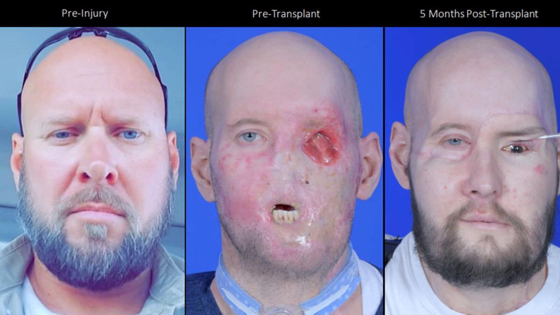 مقایسه چهره آرون پیش از جراحت، بعد از جراحت و بعد از عمل