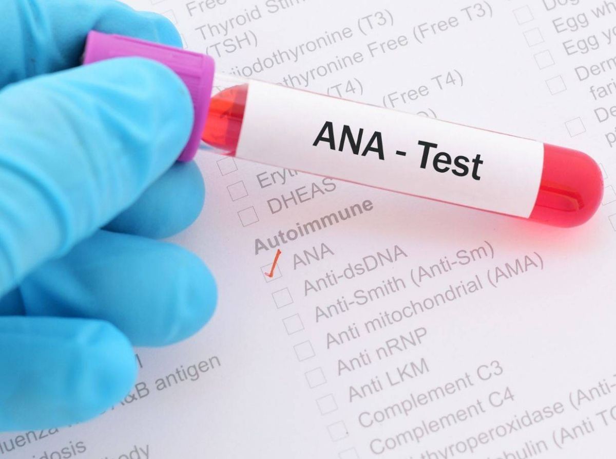 Lupus Disease Symptoms, Causes, Diagnosis And Treatment