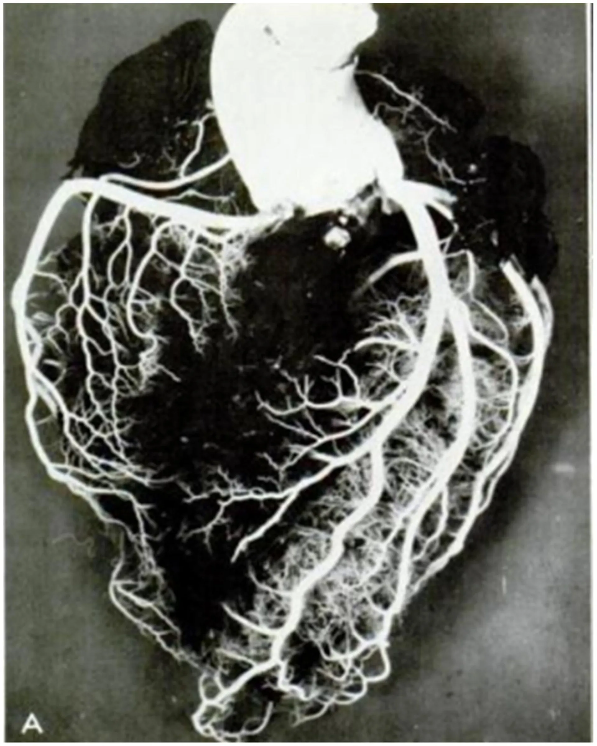 سطح قدامی قلب پس از تزریق مواد پلاستیکی