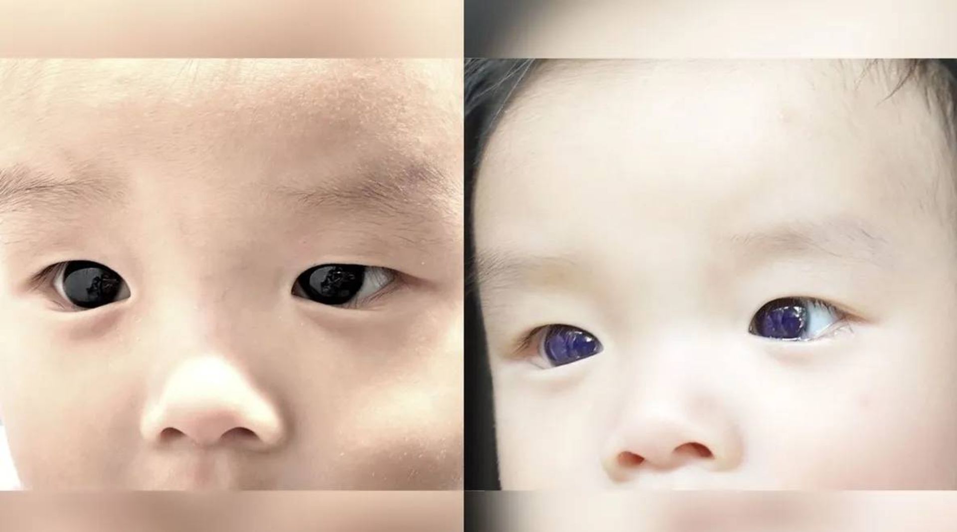 تغییر رنگ چشم نوزاد