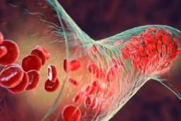 میکروپلاستیک‌ها به لخته‌های خونی قلب، مغز و پاهایمان نفوذ کرده‌اند