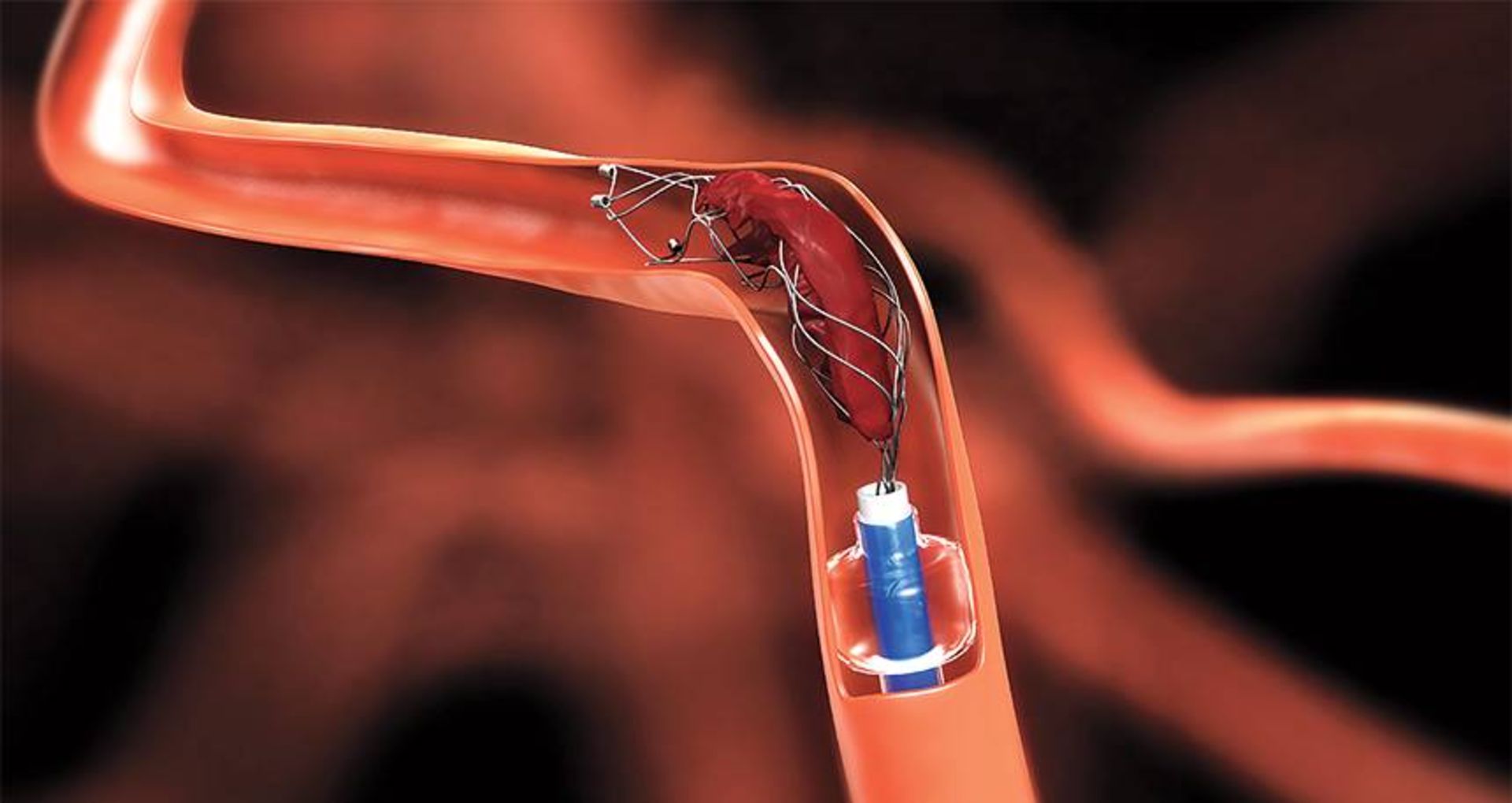 خارج کردن لخته خون از بدن