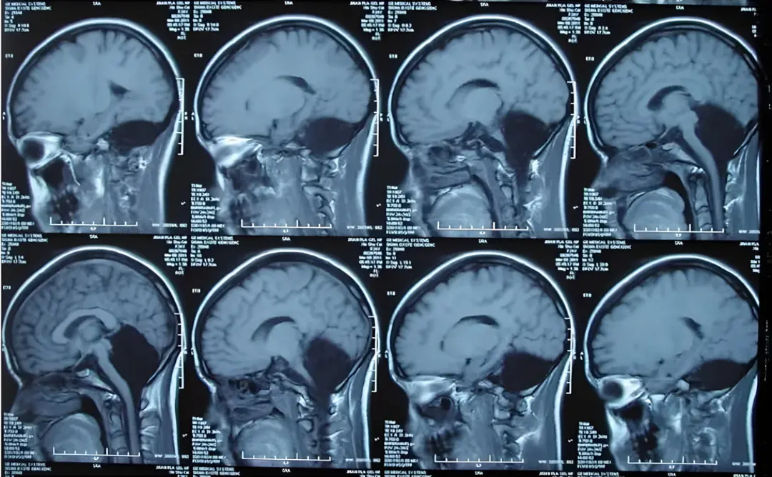 تصاویر مقاطع ساجیتال ام‌آر‌آی (MRI) از ساختار مغز انسان