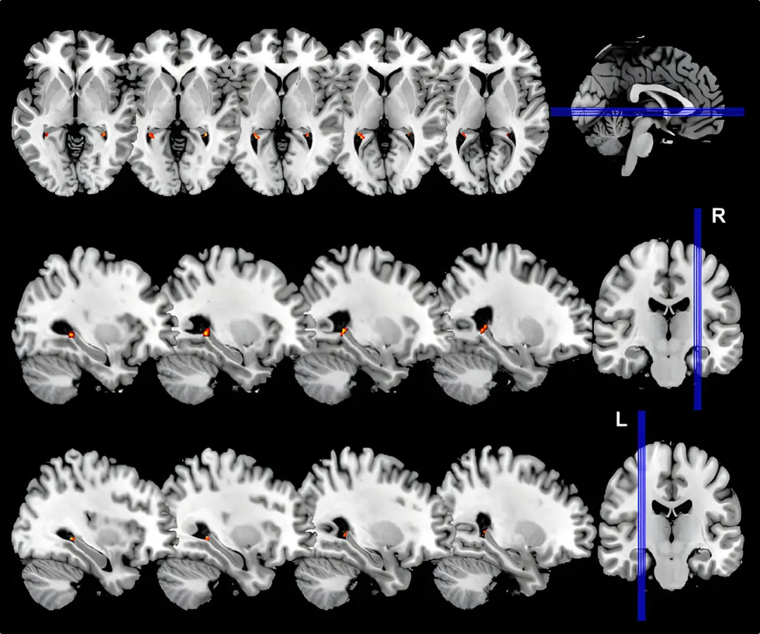 برش‌های مختلف مغز انسان در تصاویر اسکن MRI که نواحی فعال را نشان می‌دهد