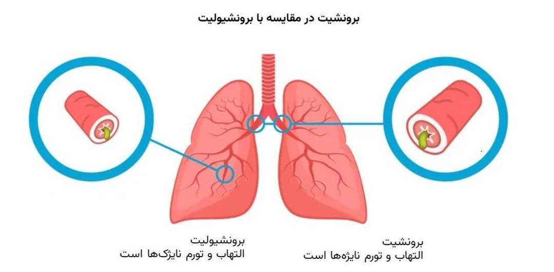 برونشیت و برونشیولیت