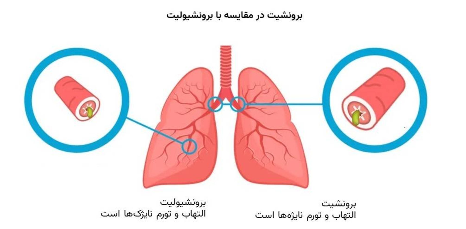 برونشیت و برونشیولیت