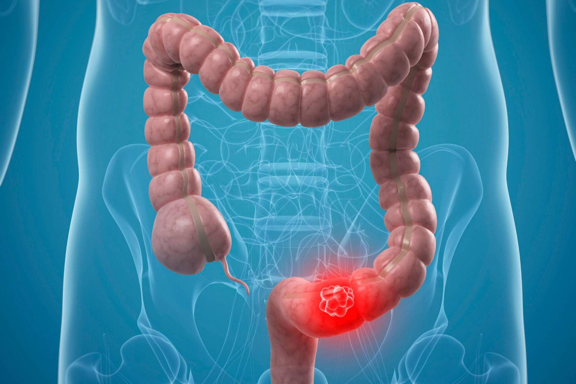 سرطان روده بزرگ