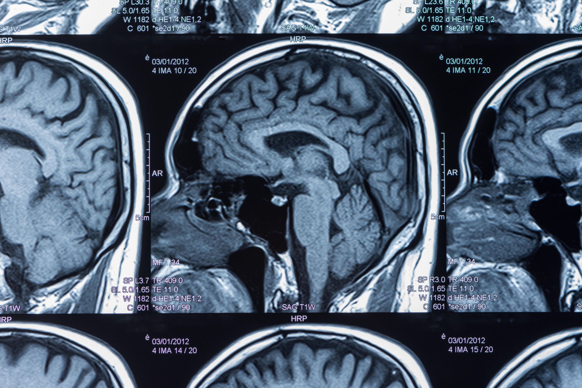 مقایسه تصاویر MRI مغز نشان می‌دهد سیلوسایبین ارتباط بین نواحی مغز را تا حد زیادی بهبود می‌بخشد