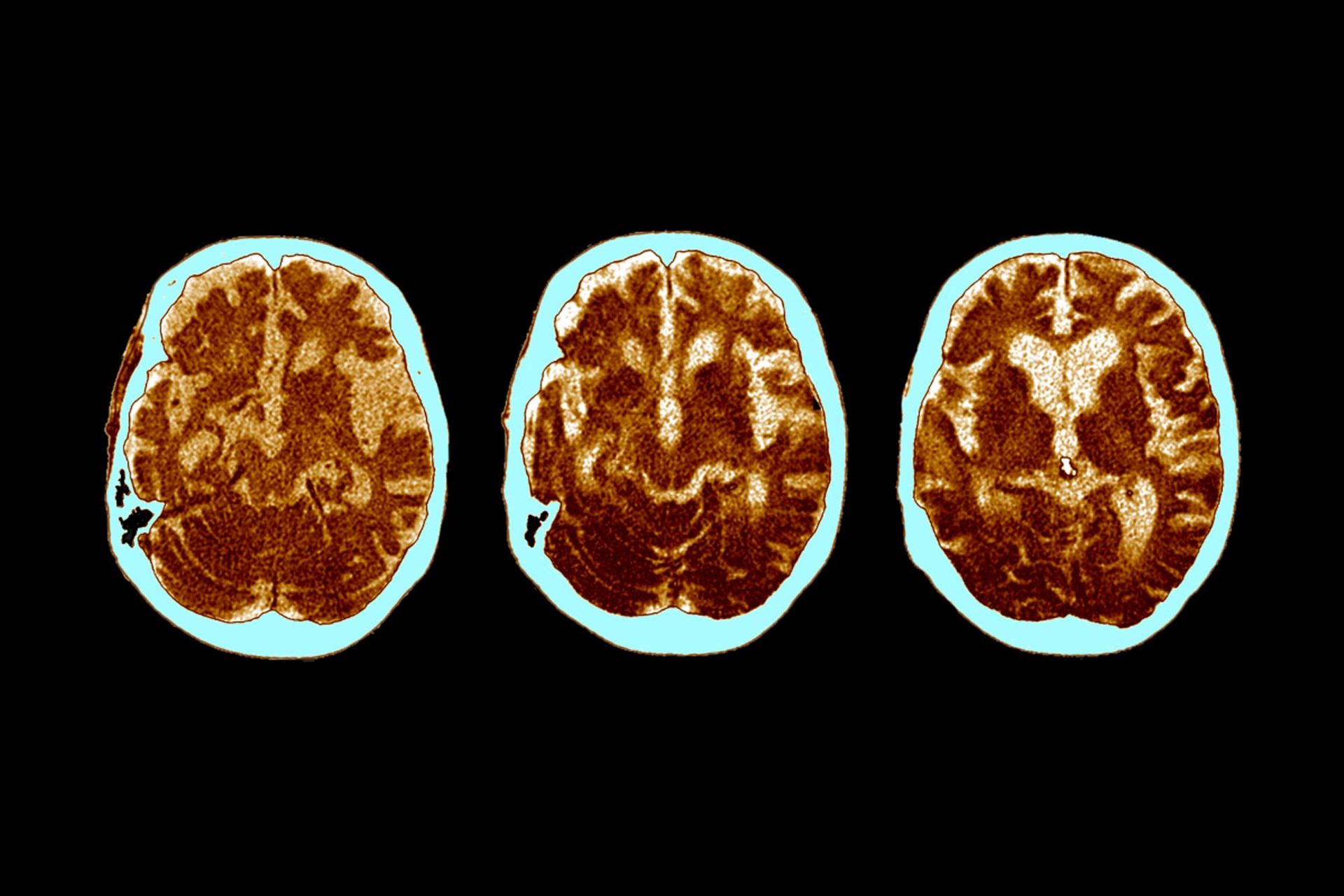 CT مغز بیماری با آلزایمر