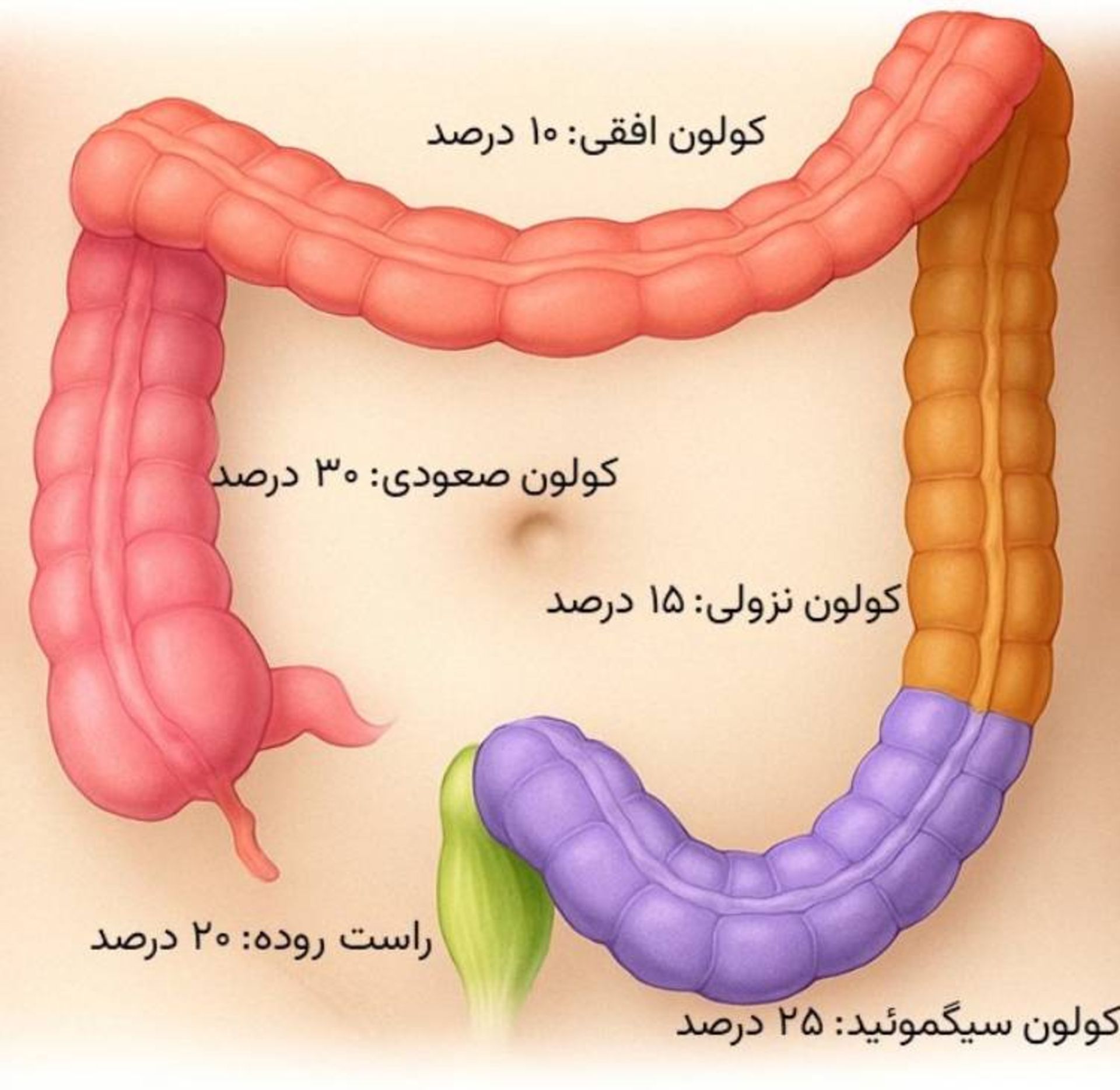 توزیع سرطان در بخش های روده بزرگ