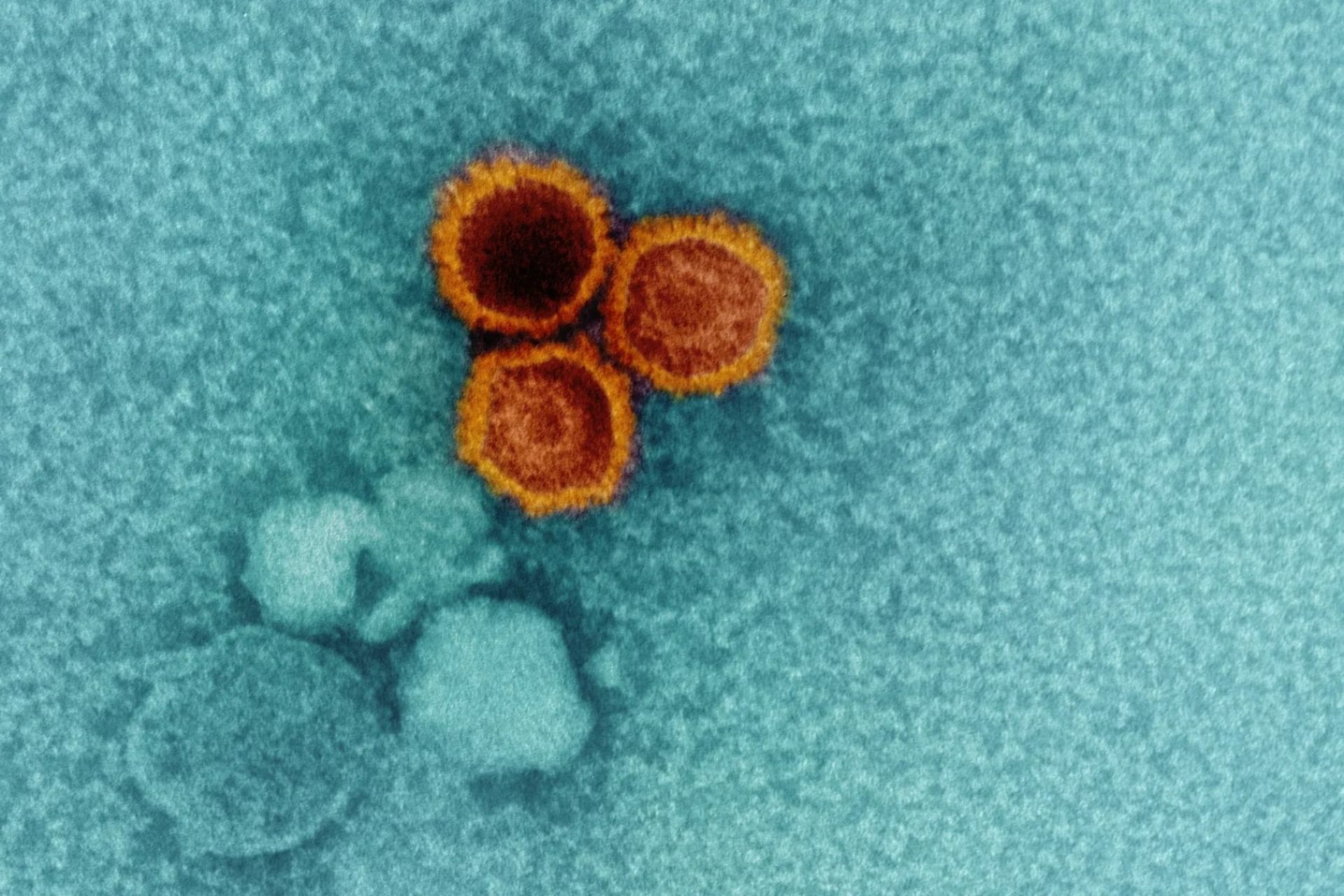 سه حباب نارنجی روی میکروگراف الکترونی ذرات ویروس اپشتین بار هستند