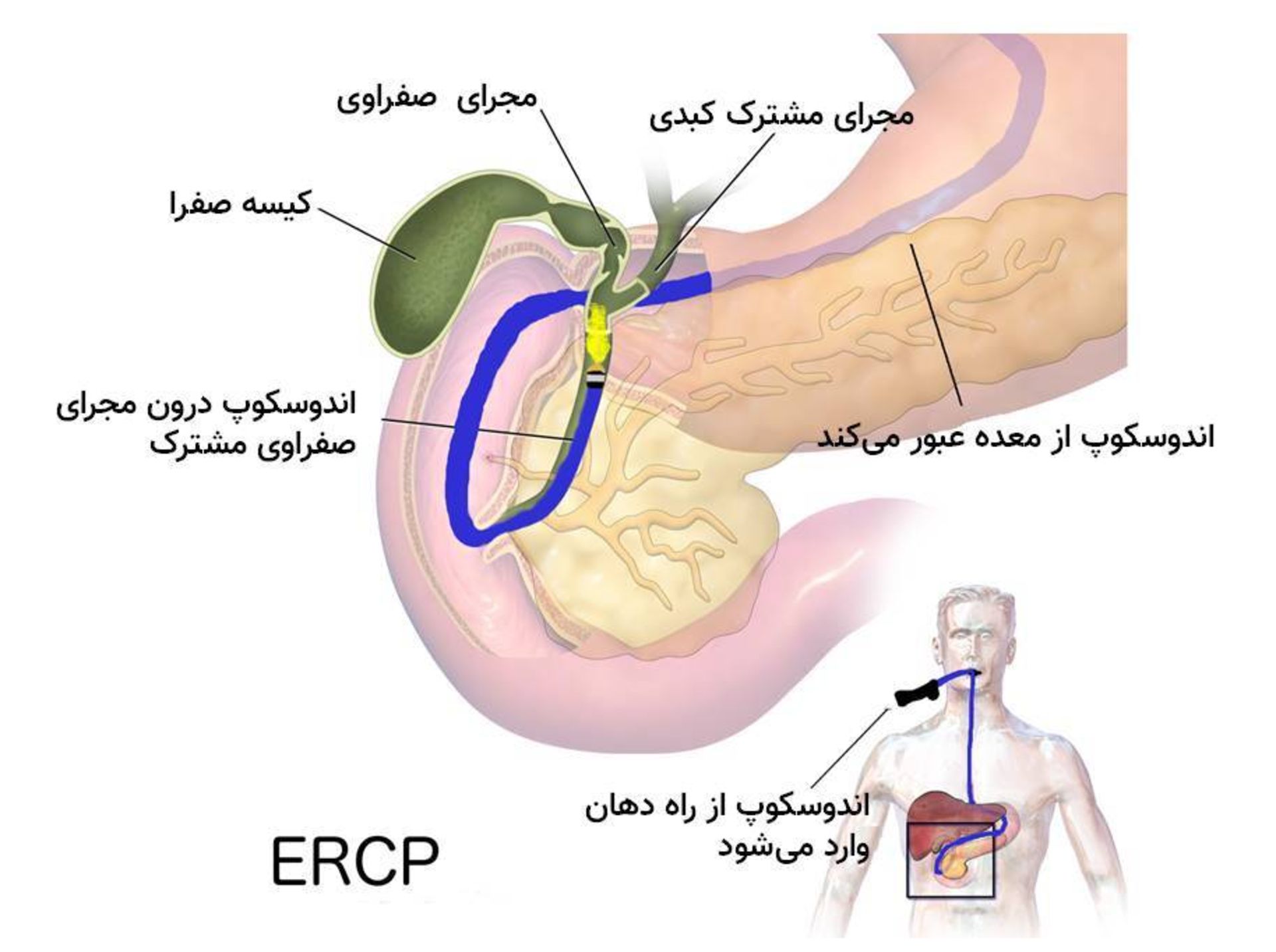 کلانژیوگرافی آندوسکوپیک عقب‌گرد 