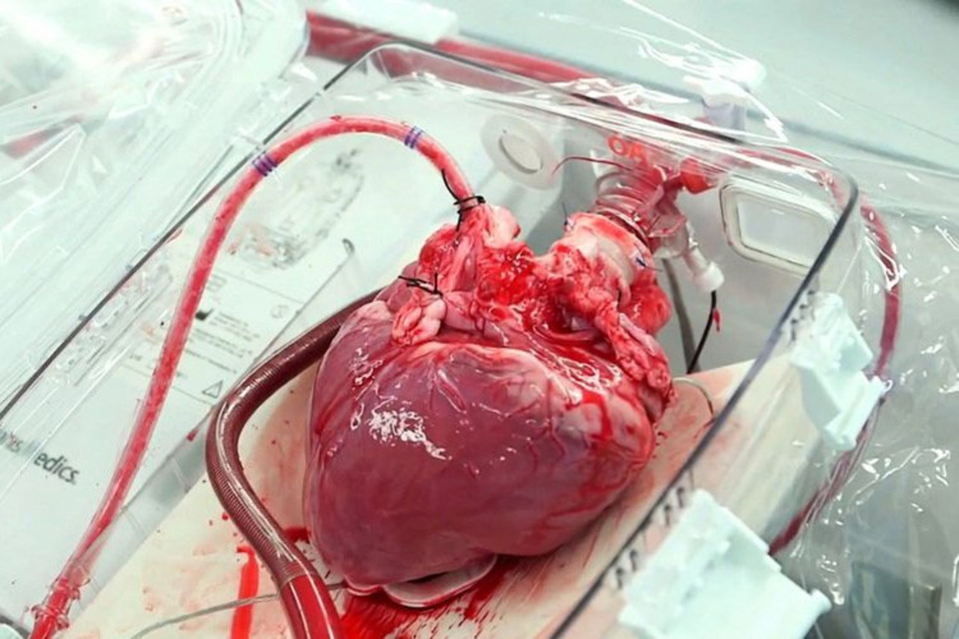 مرجع متخصصين ايران عمل جراحي پيوند قلب