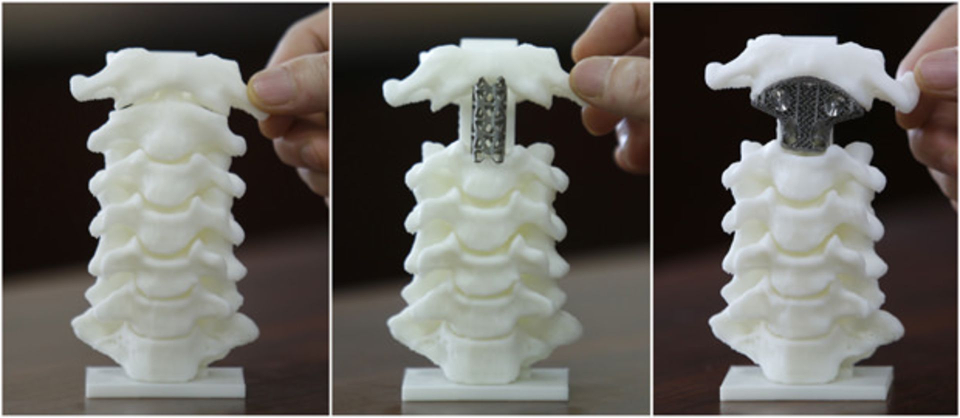 استفاده از چاپگر سه بعدی در جایگزینی مهره گردن سرطانی در چین