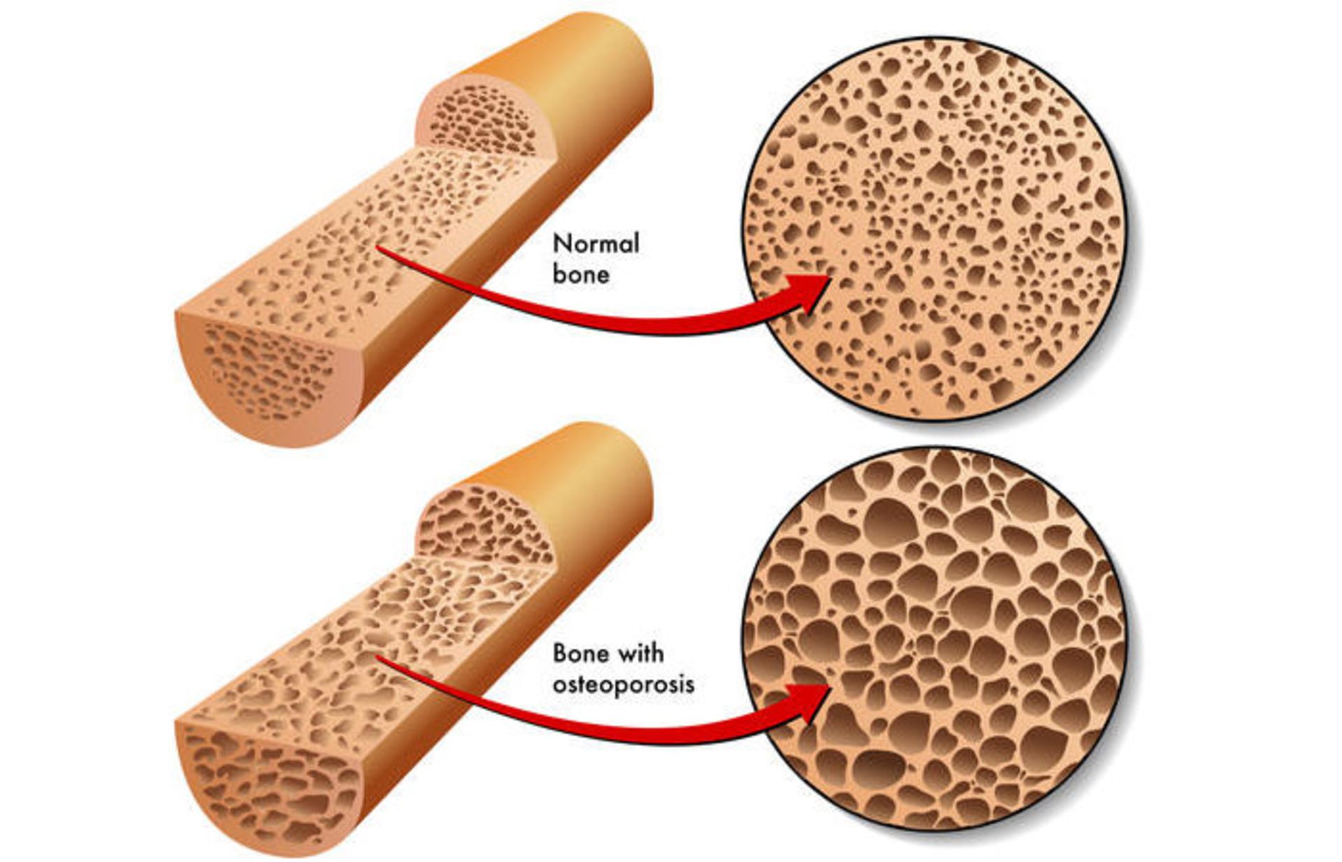 osteoporosis