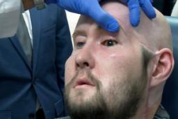 برای اولین‌ بار پیوند چشم کامل در آمریکا انجام شد