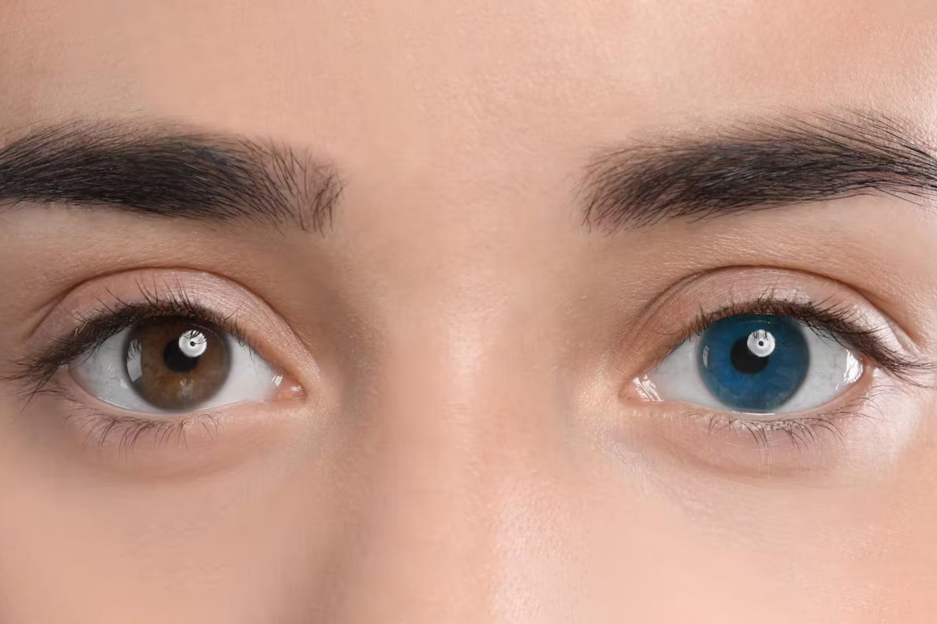 زیبایی به قیمت گزاف؛ جراحی تغییر رنگ چشم می‌تواند افراد را نابینا کند